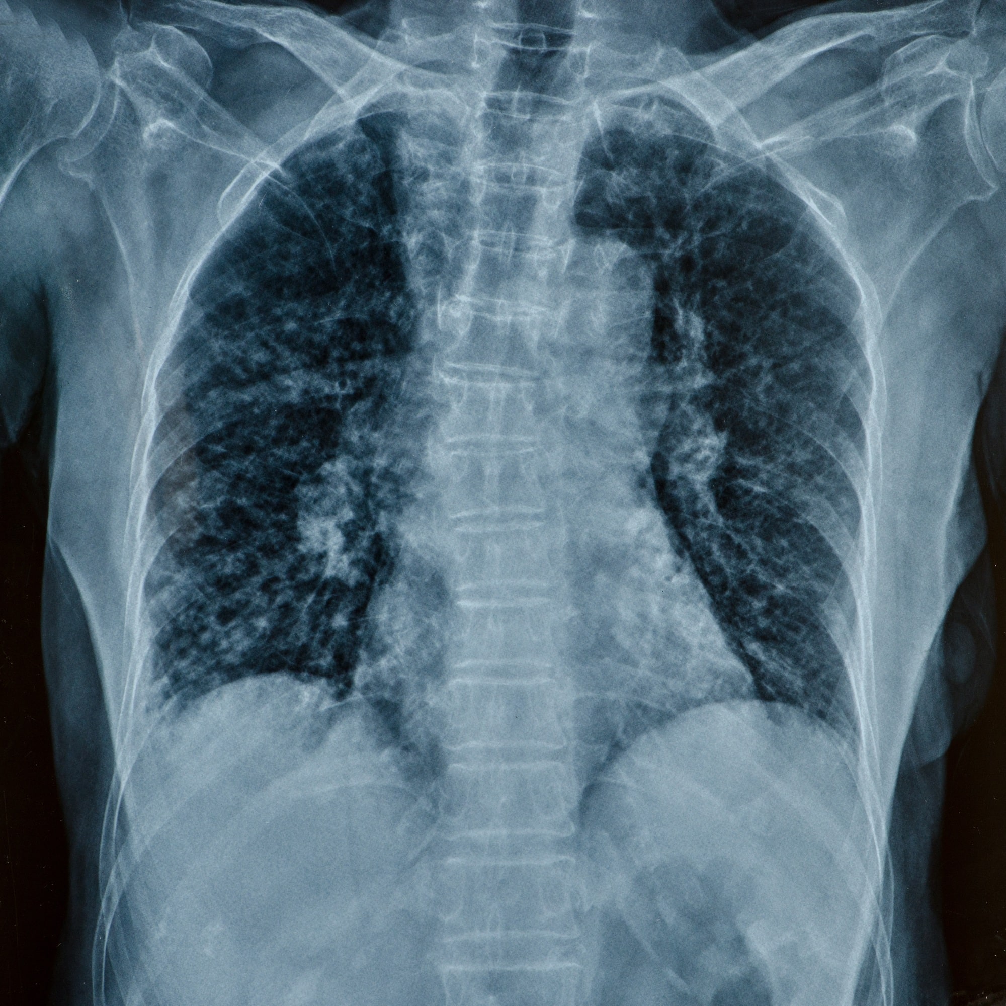 x-rays