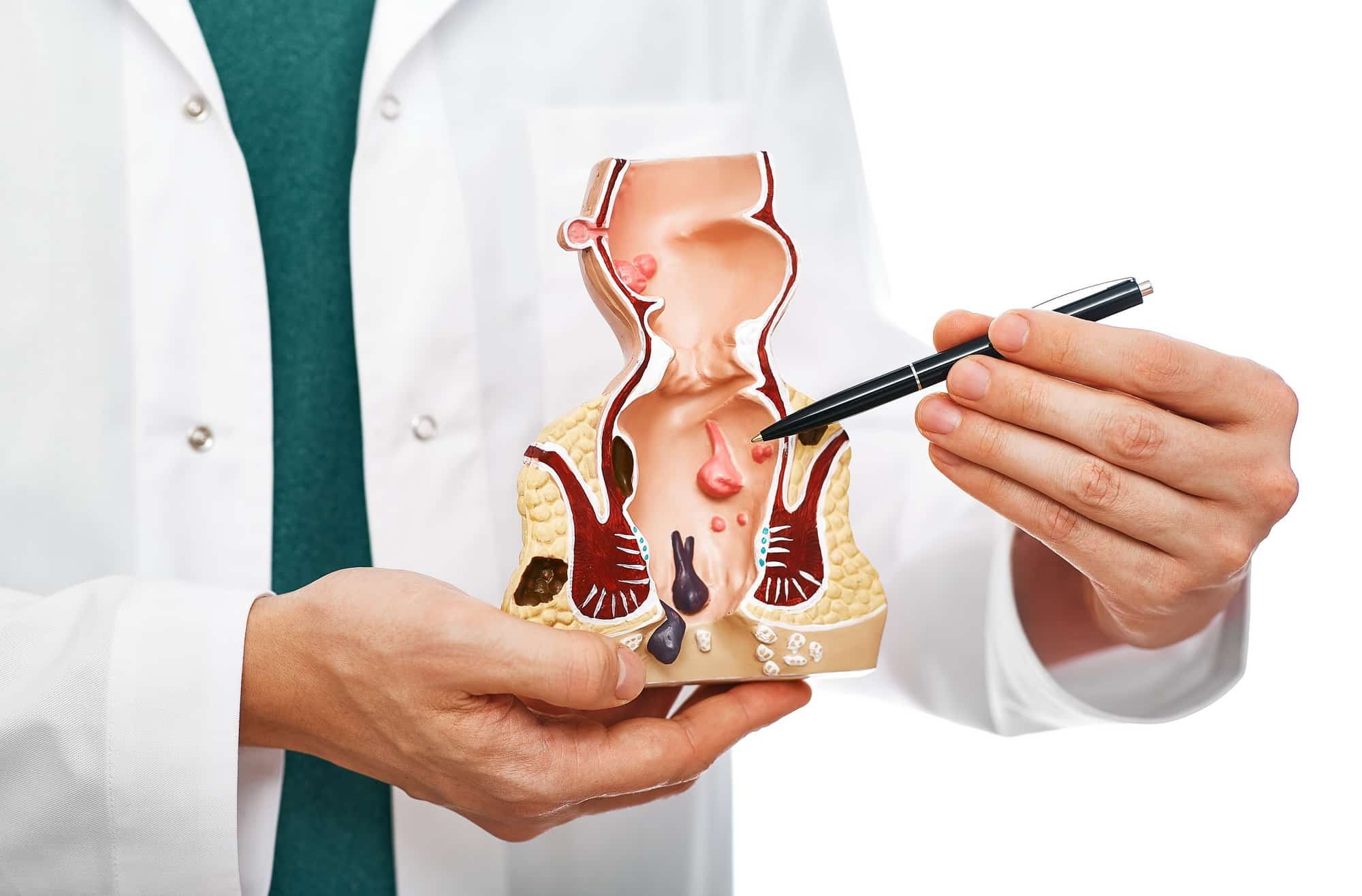 Treatment of rectal diseases, hemorrhoid. Proctologist pointing pen rectum pathologies on an